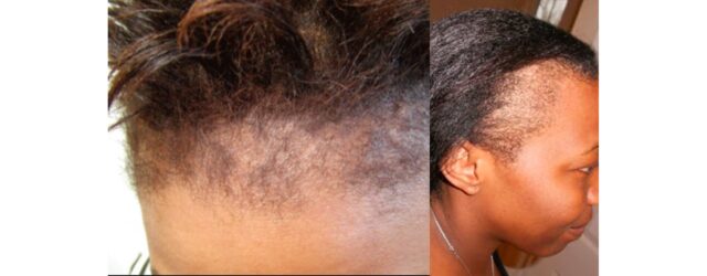 Alopécie : Comprendre la perte de cheveux et trouver des solutions